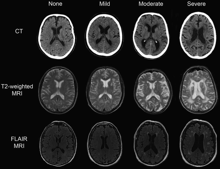 Visualizing the Brain - Brain Diseases